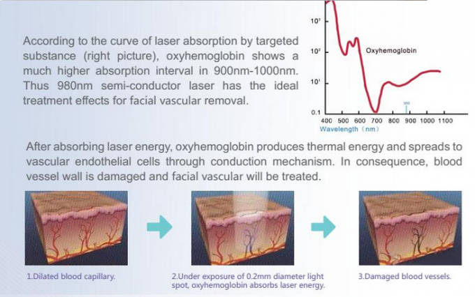 Blood Vessels Removal Diode Laser 980nm Diode Laser Varicose Veins Removal