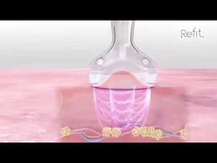 MLS05 แบบพกพา 40K Cavitation สูญญากาศ RF อัลตราโซนิกอุปกรณ์ลดเซลลูไลท์